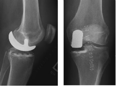 Howmedica EIUS (Implant 12)